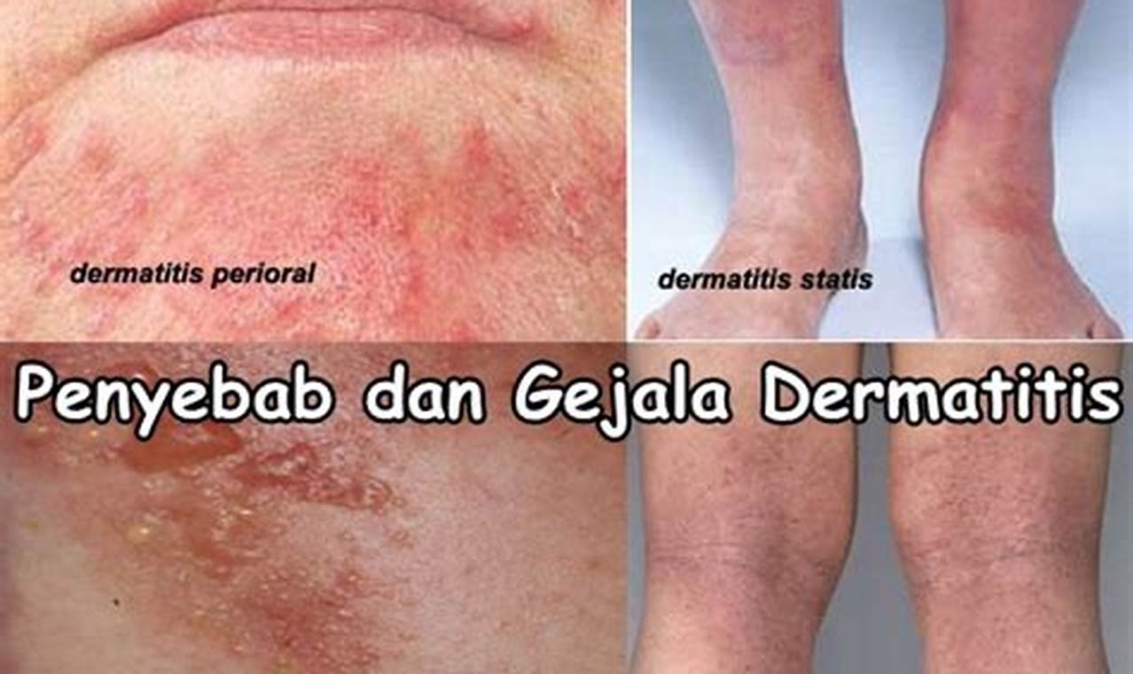 cara mengatasi gatal alergi